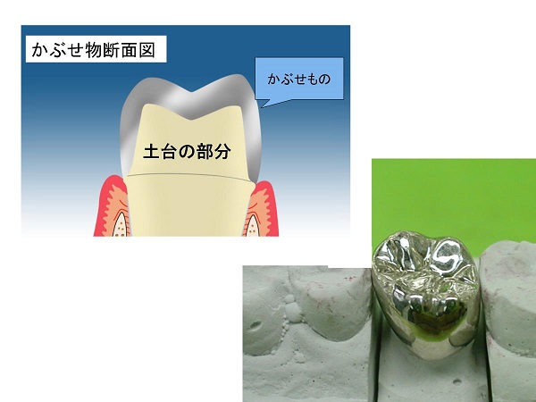 かぶせもの断面図