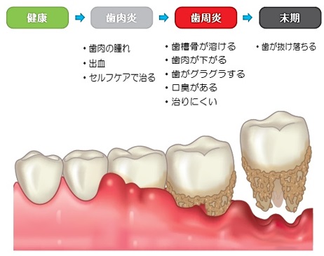 歯周病進行イラスト1