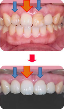 セラミックで天然の歯と区別がつかない、自然な仕上がり