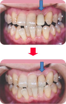 隣の歯の色になじんだ仕上げ