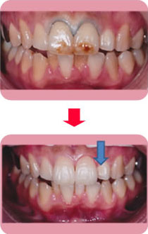隣の歯の色になじんだ仕上げ