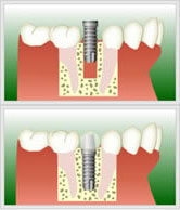 歯を削らずに処置するインプラント治療